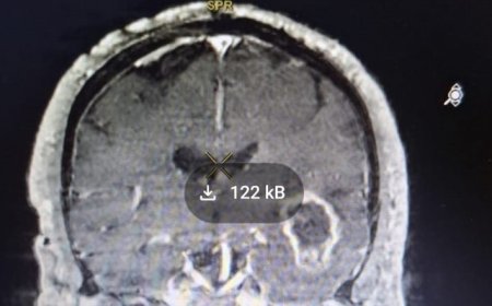 Casmu realizó primera cirugía de tumor cerebral con fluorescencia en Uruguay