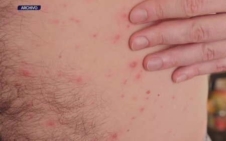 Salud Pública reportó aumento de 71,5% en casos de varicela en primeros seis meses del año respecto a 2024