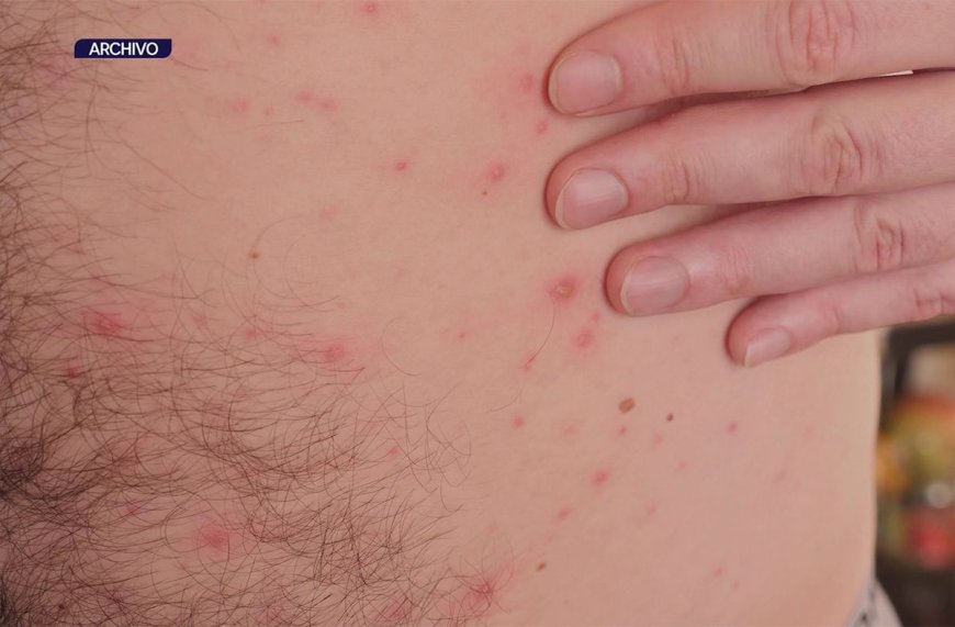 Salud Pública reportó aumento de 71,5% en casos de varicela en primeros seis meses del año respecto a 2024